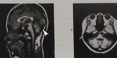 小腦萎縮的症狀 小腦萎縮會影響人的壽命嗎