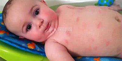 生活小常識：得了濕疹怎麼辦 寶寶有濕疹吃什麼好