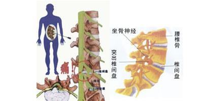 預防骨質增生的保健知識與小常識