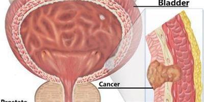 膀胱癌晚期症狀