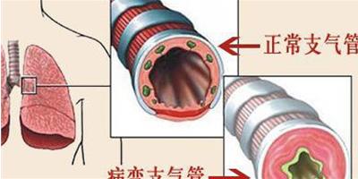 瞭解臨床上主要的支氣管炎的症狀表現