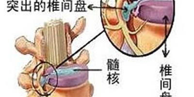 腰肌勞損可在臥室輕鬆化解