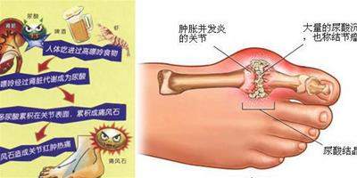 痛風患者如何在生活與飲食上護理