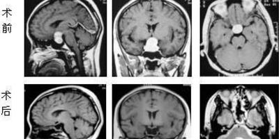 腦垂體瘤的症狀