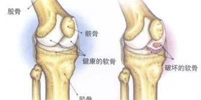 盛夏謹防空調性關節炎