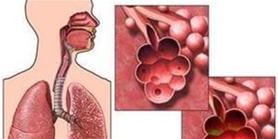 肺氣腫治療方法 肺氣腫的症狀