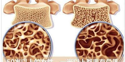 預防骨質疏鬆應從中年開始