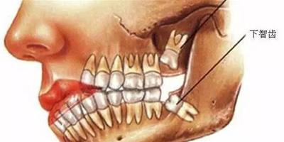 生活小常識：智齒拔了到底會不會瘦臉?