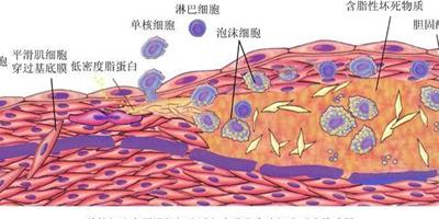 什麼是動脈粥樣硬化